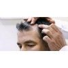 Hair Transplant in Coimbatore for an affordable cost