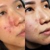 cross acne scar treatment in California