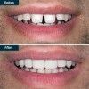 Dental Bonding (Cosmetic Teeth Bonding)