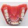 Denture processing, denture processing plant, zirconia porcelain teeth, invisible teeth, pure titanium baking