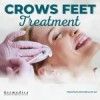 Crows Feet Treatment available at Dermedica